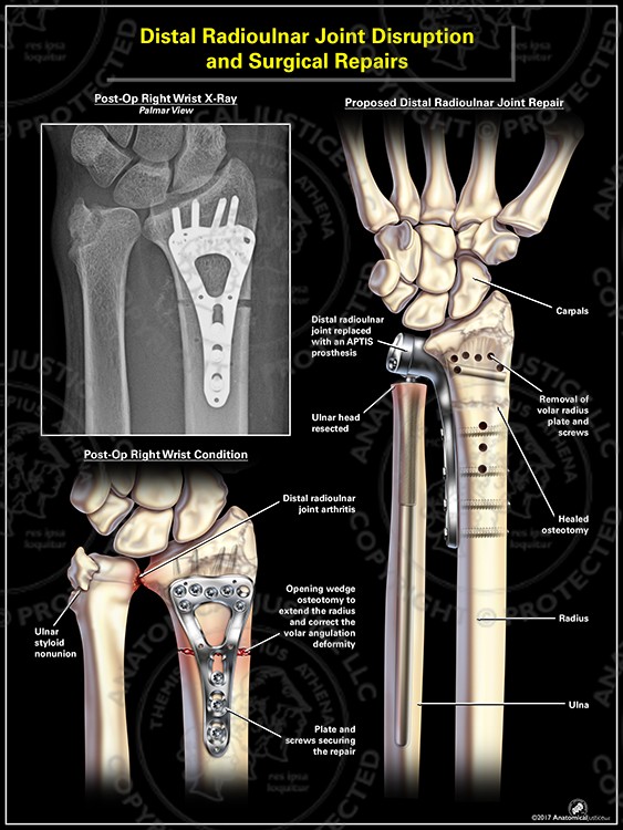 Distal Radioulnar Joint Disruption and Surgical Repairs