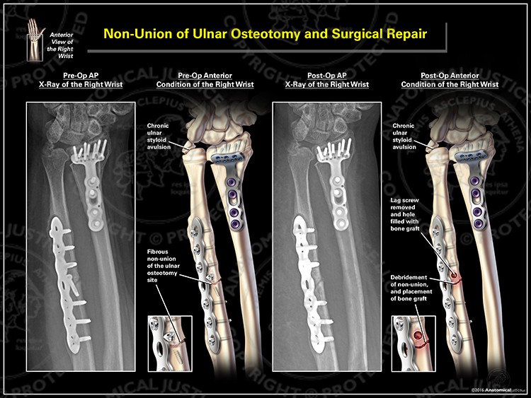Non-Union of Ulnar Osteotomy and Surgical Repair