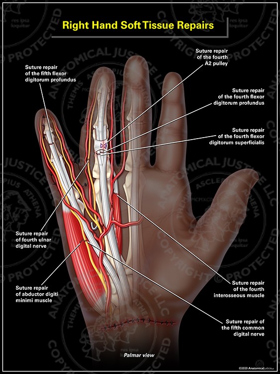 Right Hand Soft Tissue Suture Repairs