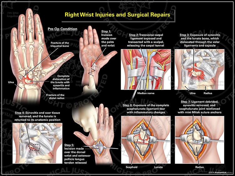 Right Wrist Injuries and Surgical Repairs