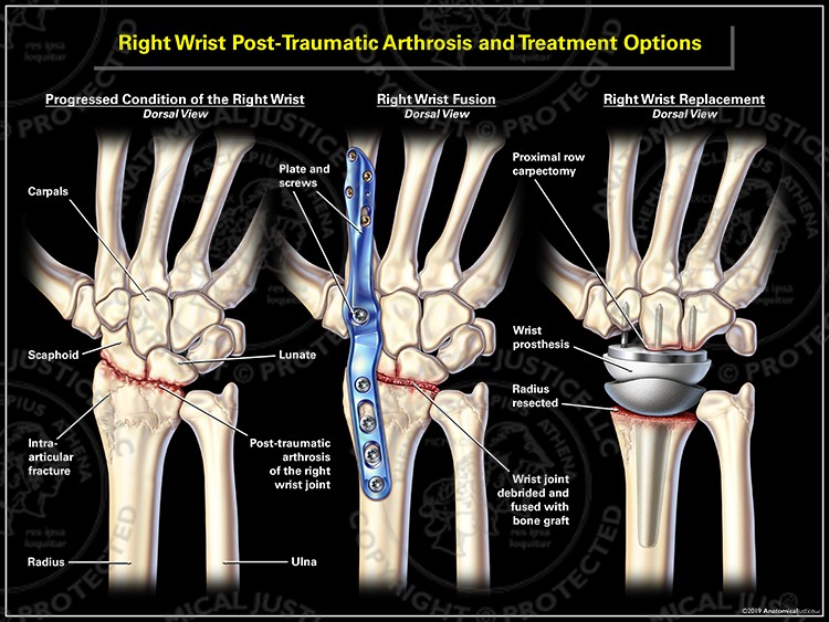 Right Wrist Post-Traumatic Arthrosis and Treatment Options