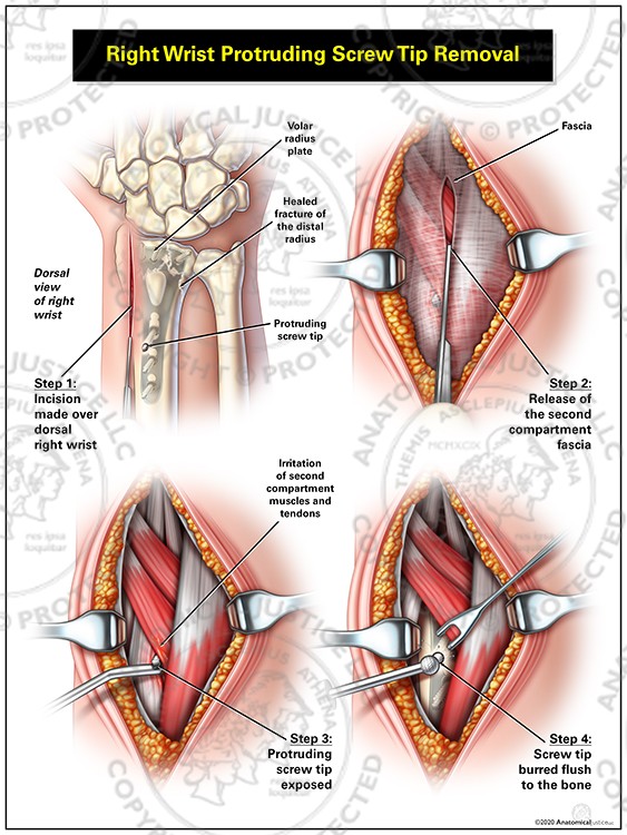 Right Wrist Protruding Screw Tip Removal