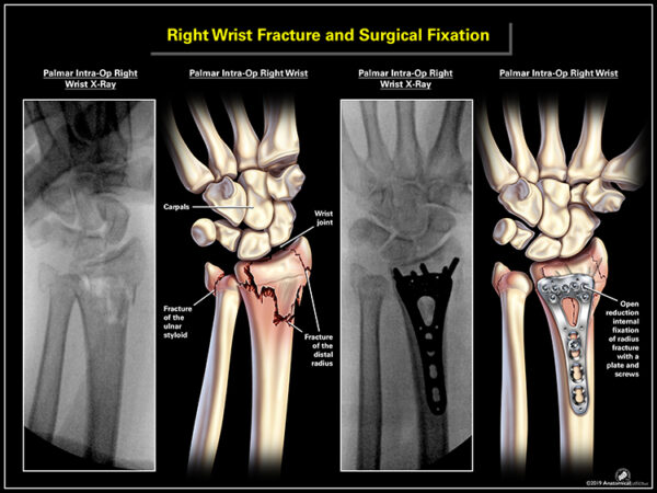 Right Wrist Fracture And Surgical Fixation Radiology Illustration 