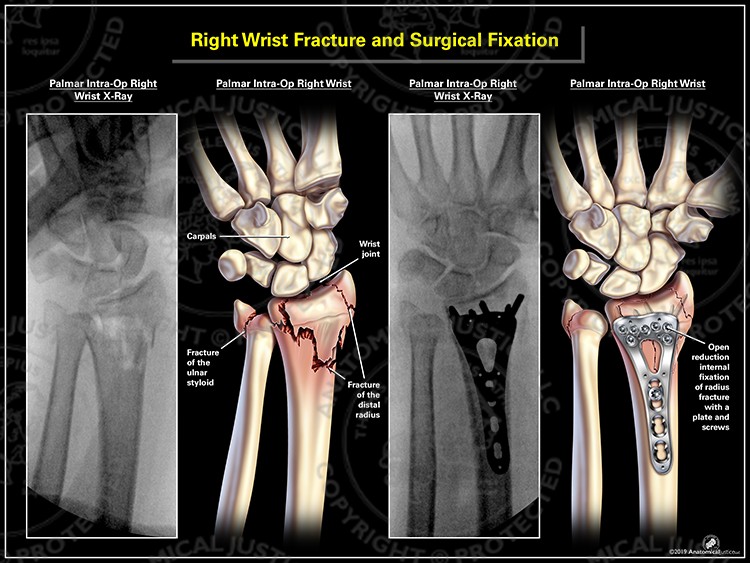 Right Wrist Fracture And Surgical Fixation