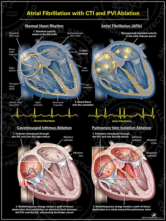 Atrial Fibrillation With CTI And PVI Ablation Custom Medical Atrial Fibrillation With CTI And PVI Ablation Custom Medical