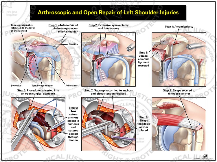 Arthroscopic and Open Repair of Left Shoulder Injuries