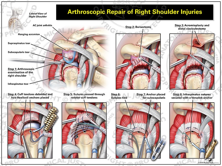 Arthroscopic Repair of Right Shoulder Injuries
