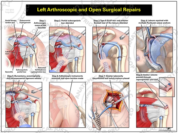 Left Arthroscopic and Open Surgical Repairs