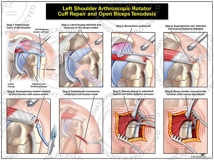 Left Shoulder Arthroscopic Rotator Cuff Repair and Open Biceps Tenodesis