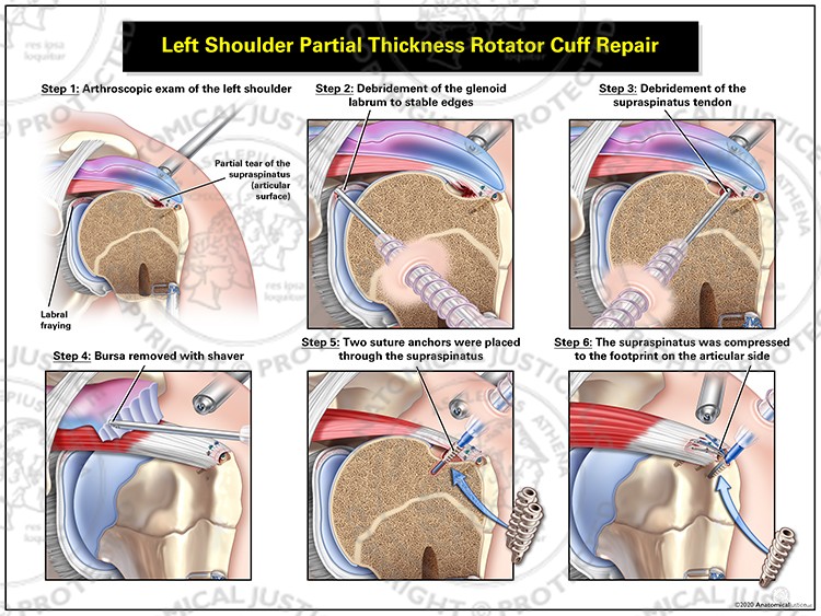 Left Shoulder Partial Thickness Rotator Cuff Repair
