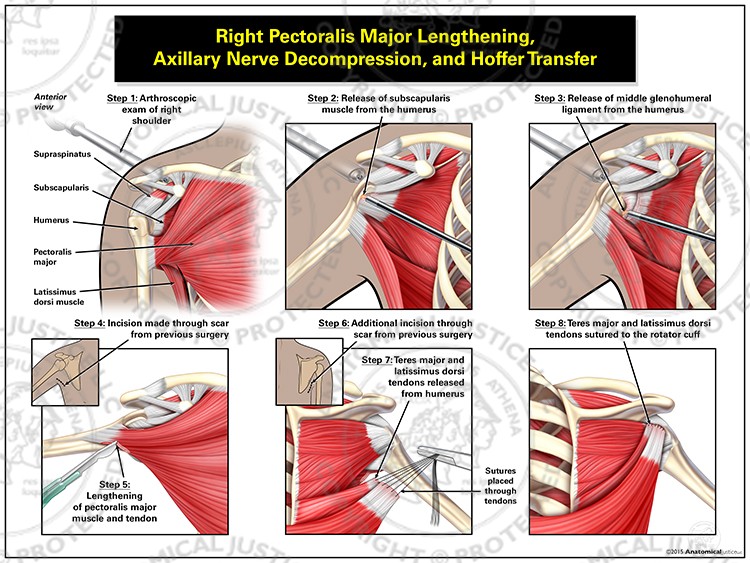 Right Pectoralis Major Lengthening, Axillary Nerve Decompression, and Hoffer Transfer