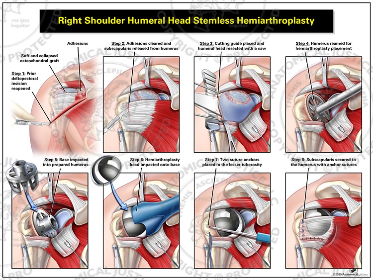 Right Shoulder Humeral Head Stemless Hemiarthroplasty