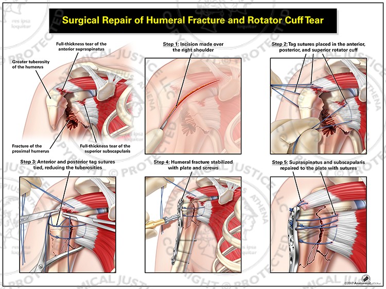 Surgical Repair of Humeral Fracture and Rotator Cuff Tear