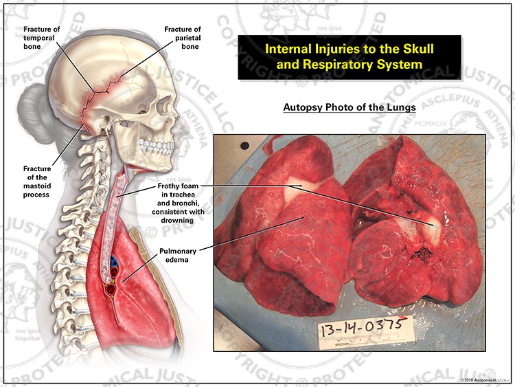 Internal Injuries to the Skull and Respiratory System