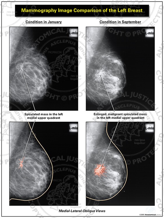 Mammography Image Comparison of the Left Breast