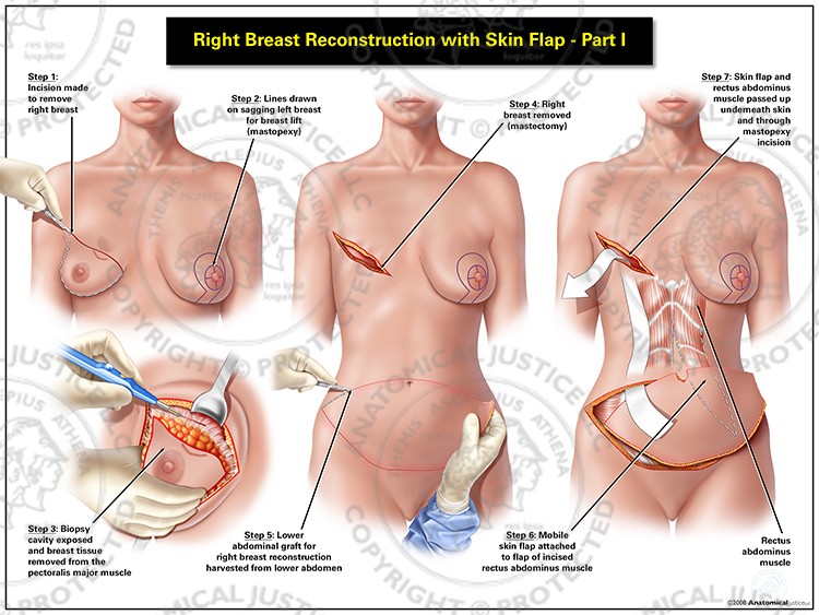 Right Breast Reconstruction with Skin Flap